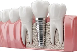 Dental Implant
